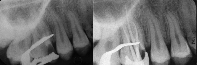 Endodonzia - Terapia canalre