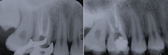 Endodonzia - Terapia canalre