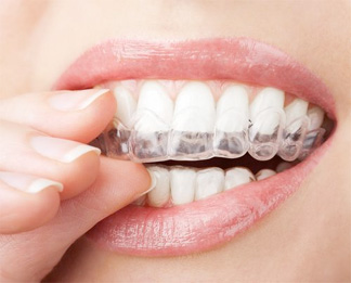 invisalign - ortodonzia invisibile