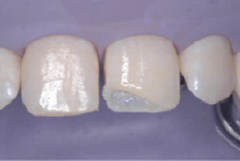 restaurativa - Restauro dente