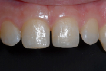 restaurativa - Restauro dente